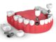 The Pros And Cons Of Dental Implants