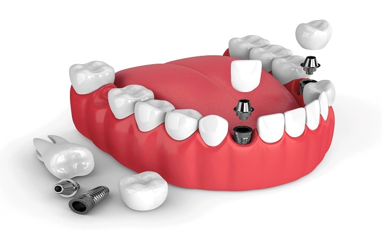 The Pros And Cons Of Dental Implants The Pros And Cons Of Dental Implants
